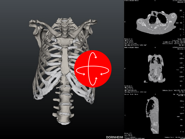 View the location of the clavicle in the viewer